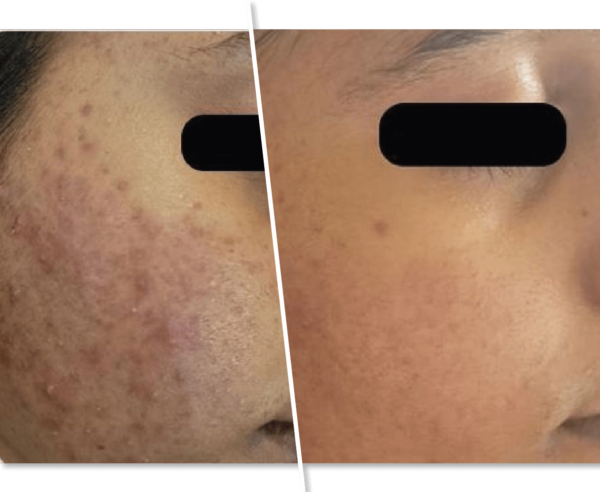 Young girl Before and After Skin Treatment